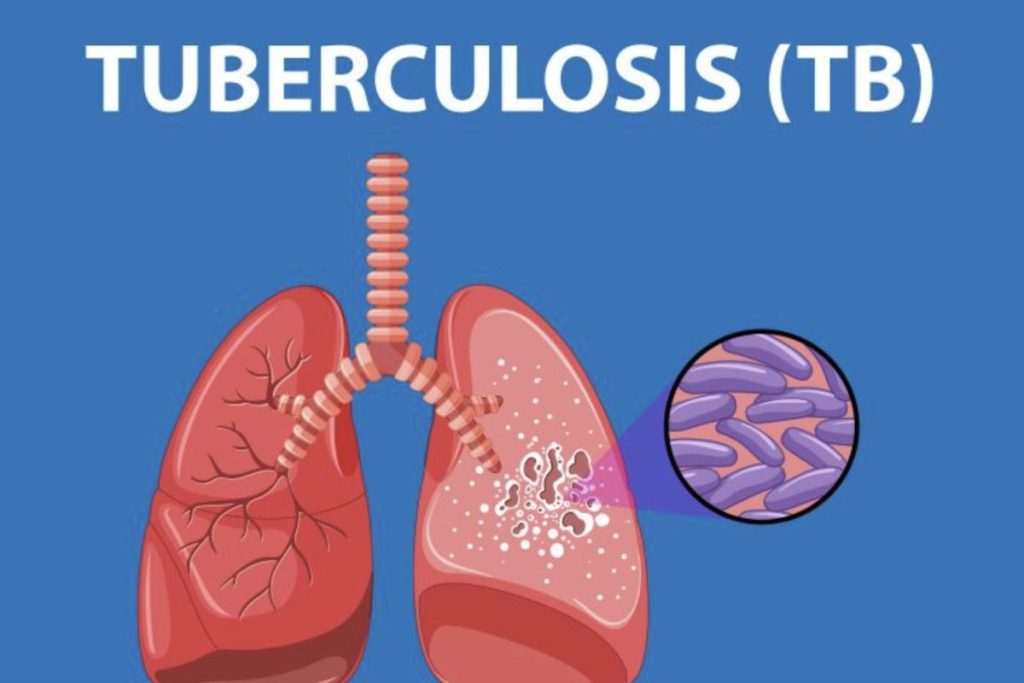 waspadai-batuk-berkepanjangan-bisa-jadi-tanda-tuberkulosis-menurut-dokter-spesialis-paru