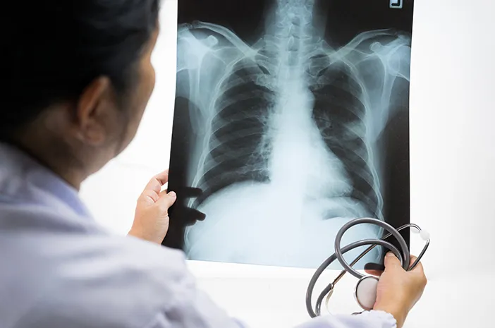 Jangan Anggap Sepele! Ini Gejala TBC yang Sering Terabaikan Menurut Dokter Paru